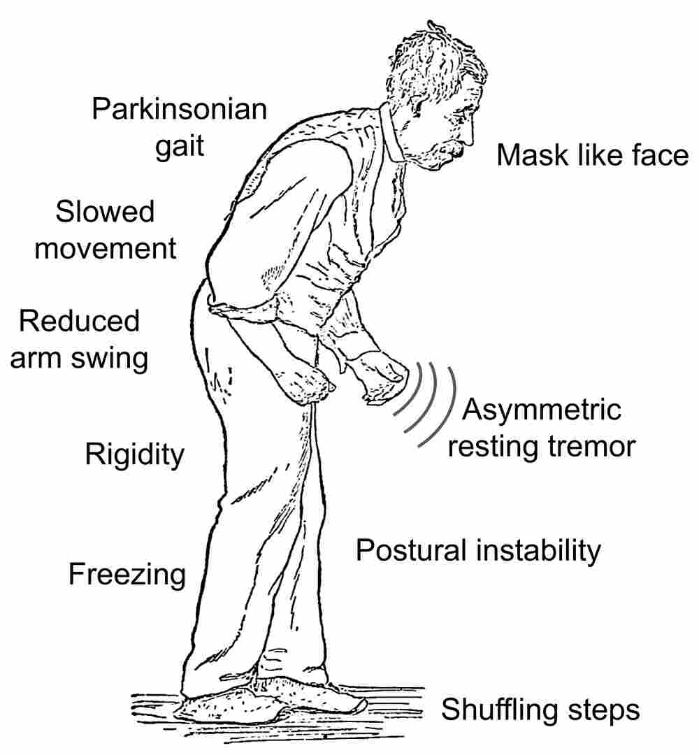 Symptoms of Parkinsons